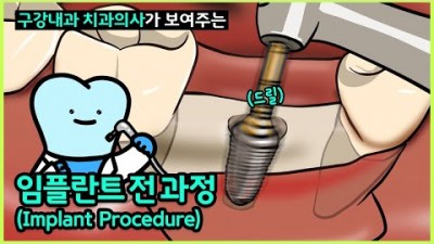 임플란트 수술 과정 임플란트 식립 뼈이식 가격 비용 치과 마다 가격 차이 나는 이유